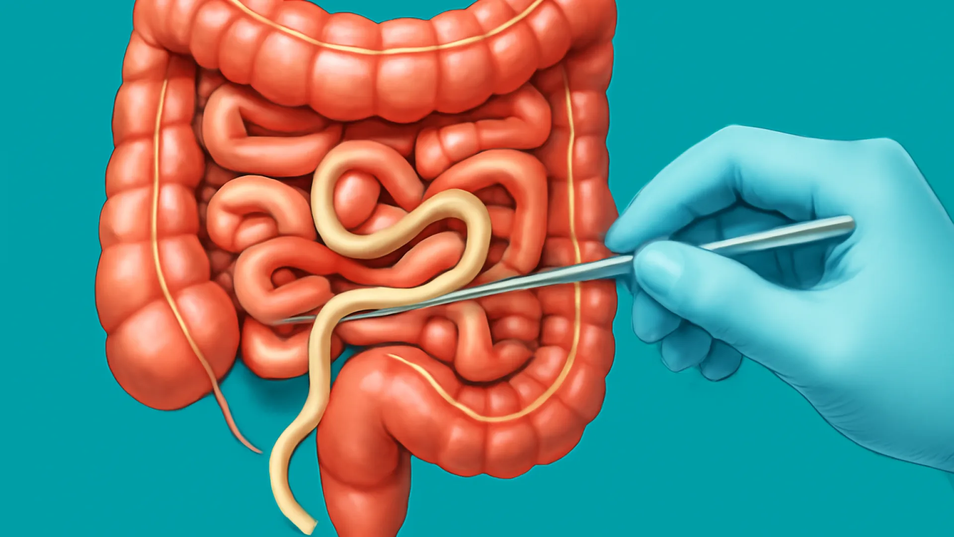 Helmintiasis (Infeksi Cacing pada Manusia)