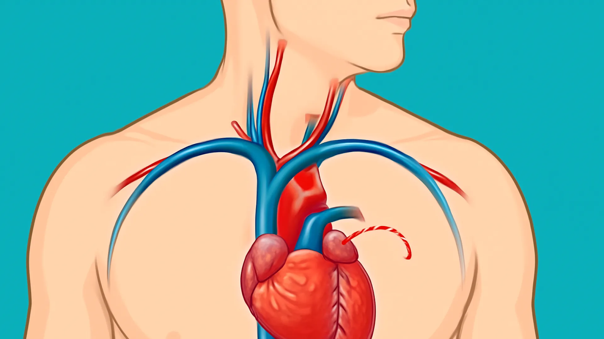 Subclavian Steal Syndrome