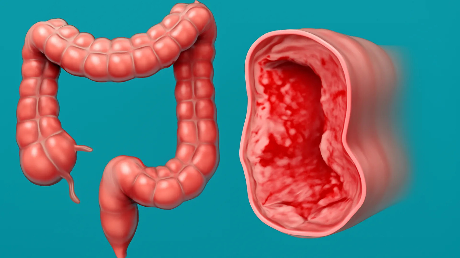 Inflammatory Bowel Disease (IBD): Crohn vs. Kolitis Ulseratif
