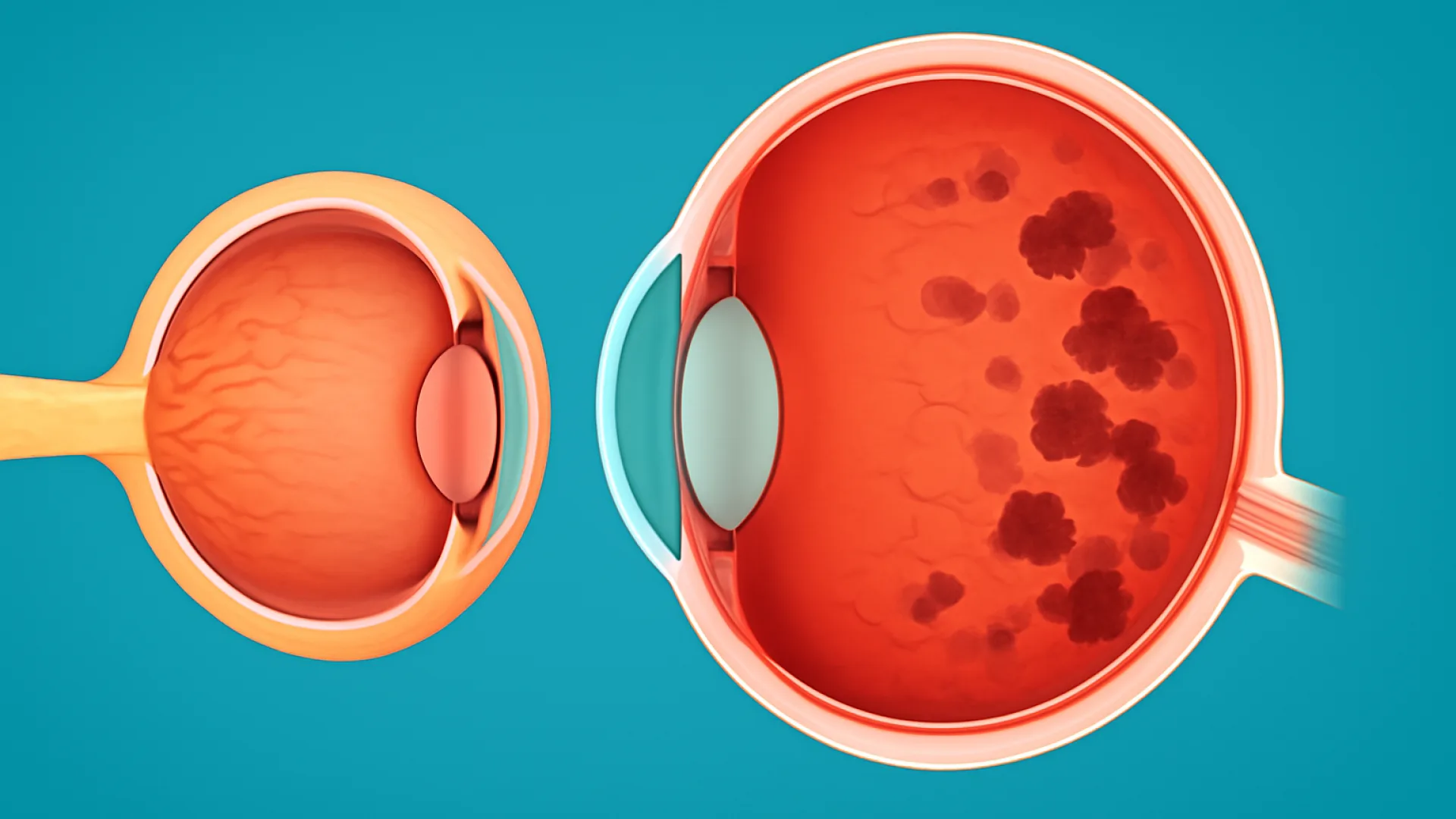 Neuritis Optik, Atrofi Optik, dan Retinitis Pigmentosa: Tiga Gangguan Optik Penting