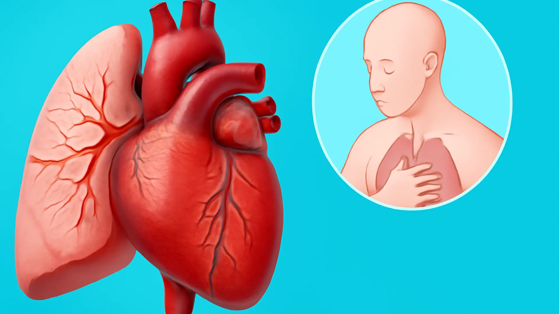 Cor Pulmonale