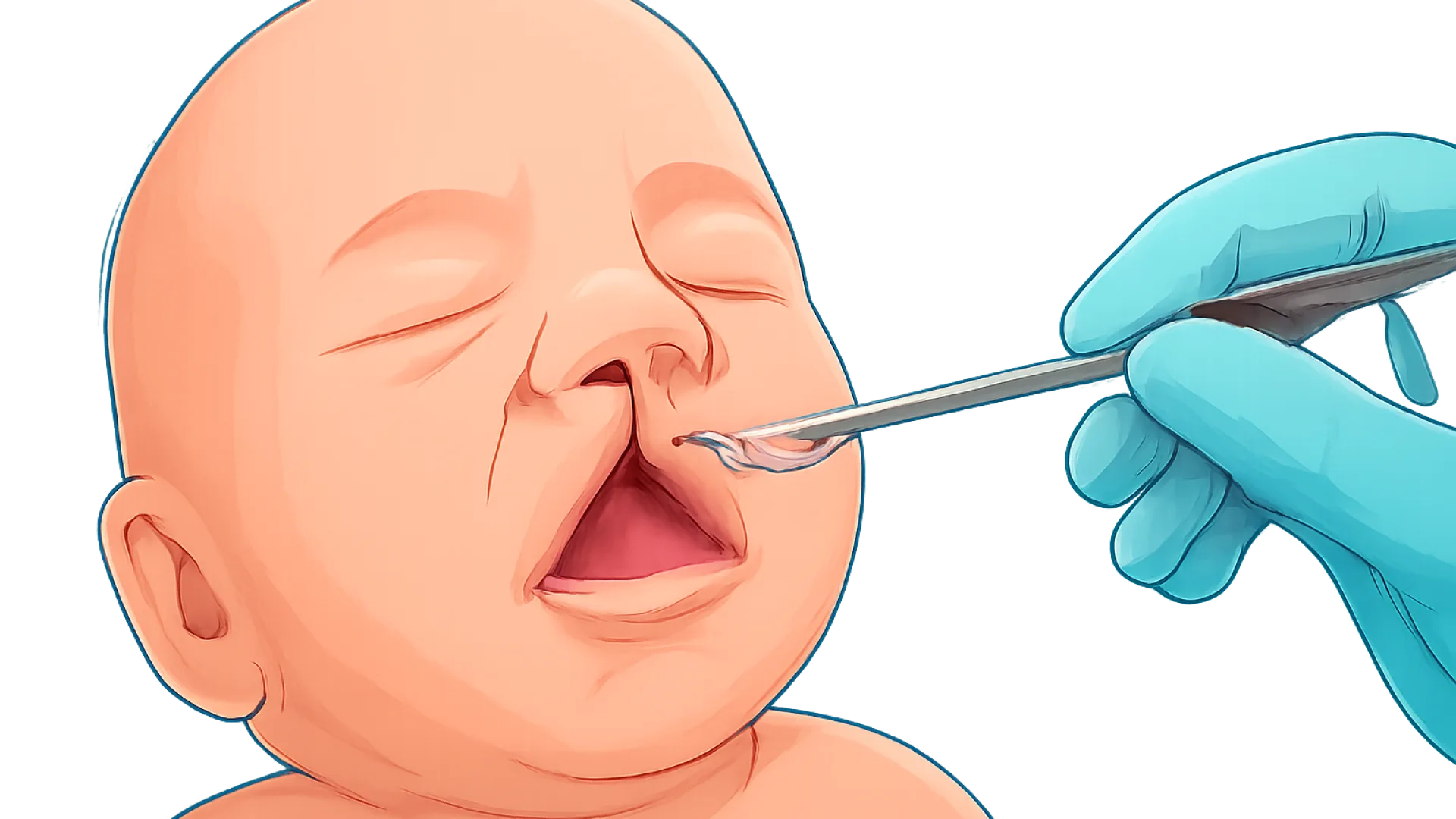 Cleft Lip Palate (Labiopalatoskisis)