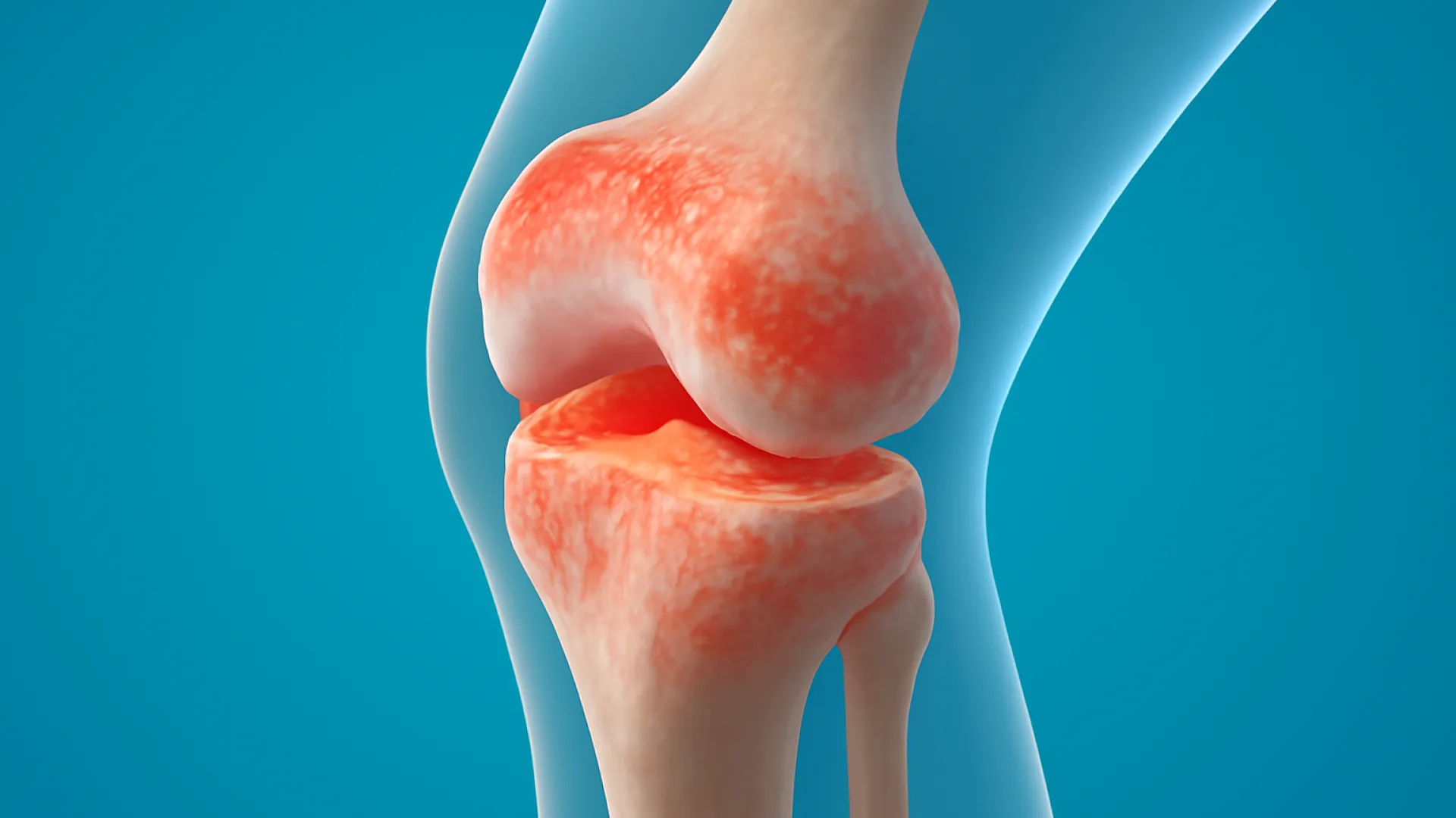 Arthritis: Mengenali Ragam Nyeri Sendi