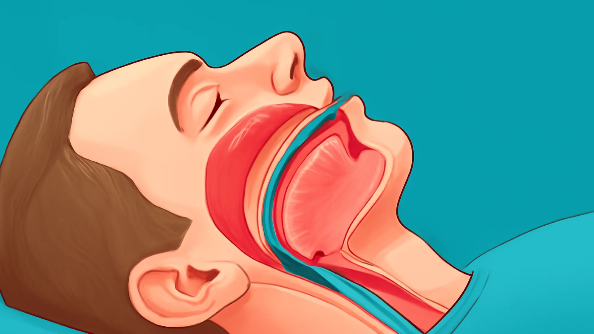 Obstructive Sleep Apnea (OSA)