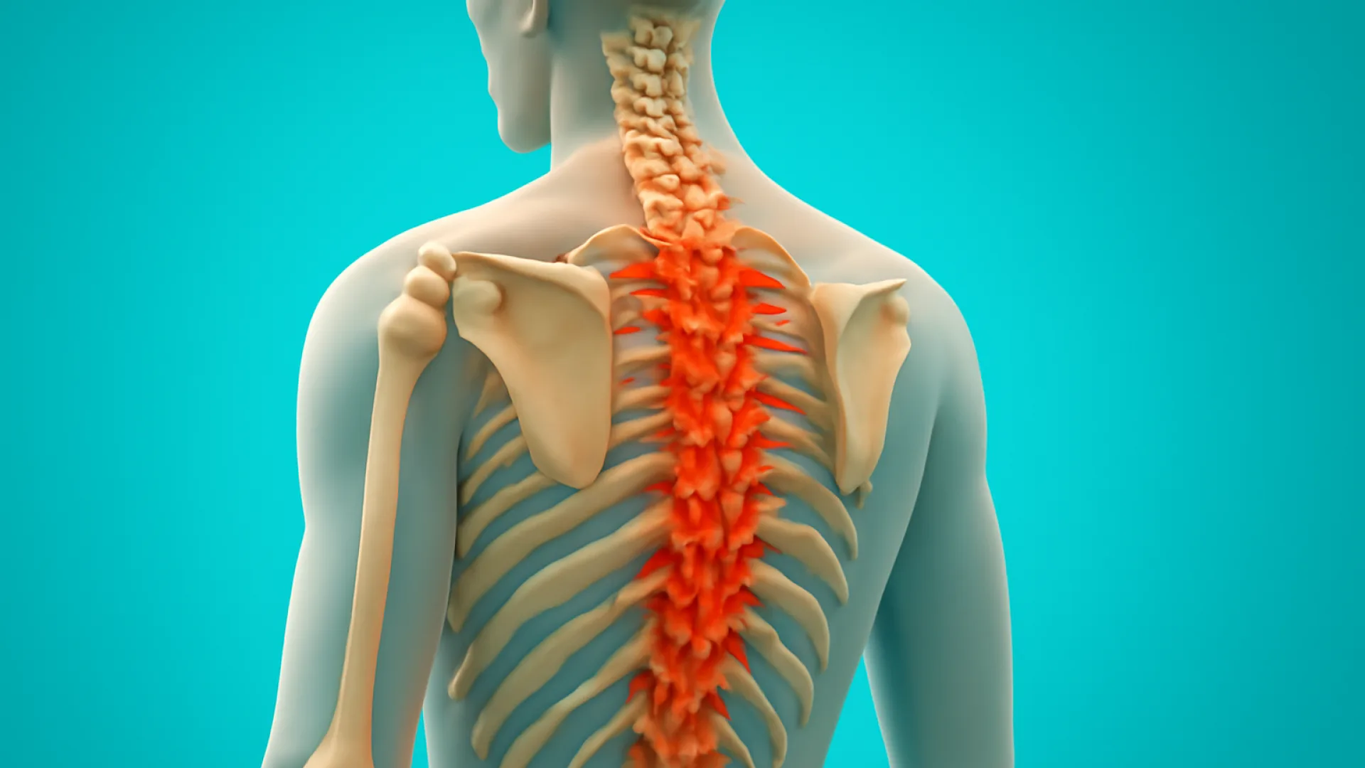Ankylosing Spondylitis dan Spondilitis Tuberkulosis: Diagnosis Banding Penting