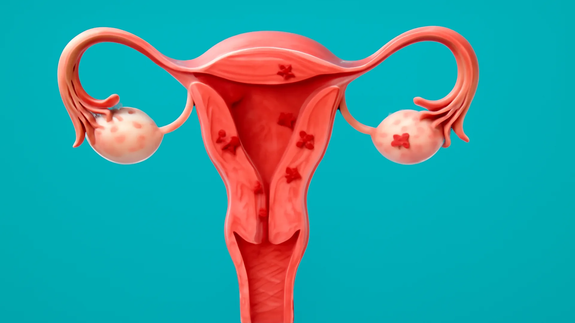 Endometriosis dan Adenomiosis
