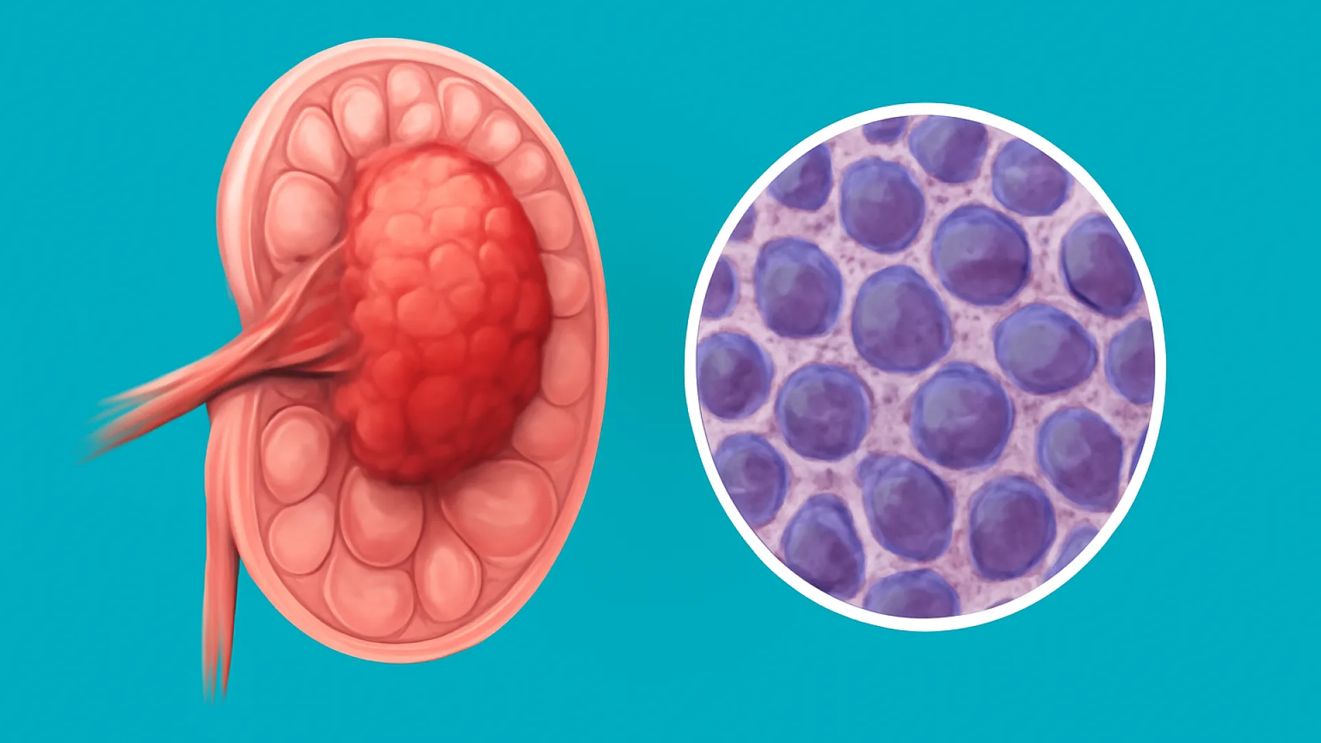 Limfoma: Klasifikasi, Diagnosis, dan Gambaran Umum