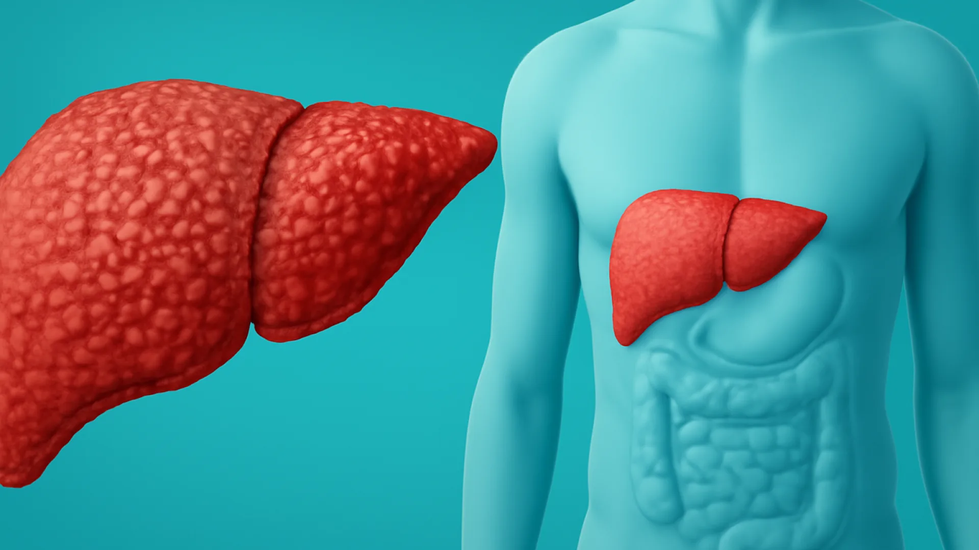 Sirosis Hepatis