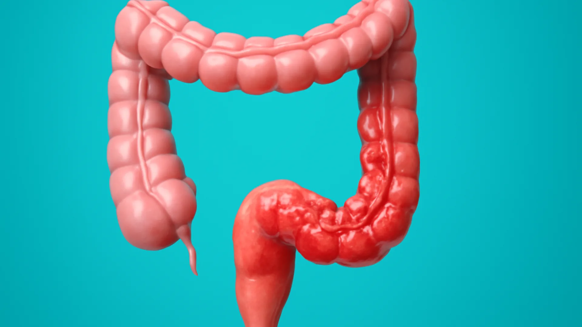 Inflammatory Bowel Disease (IBD): Perbandingan Crohn's Disease dan Ulcerative Colitis