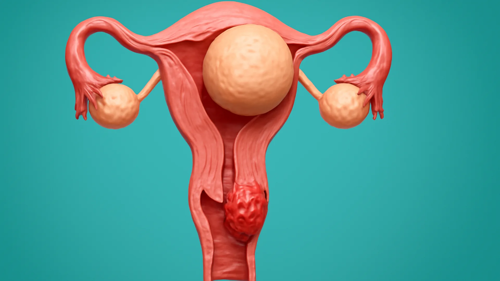 Mioma Uteri dan Kanker Serviks: Patologi Ginekologi Esensial