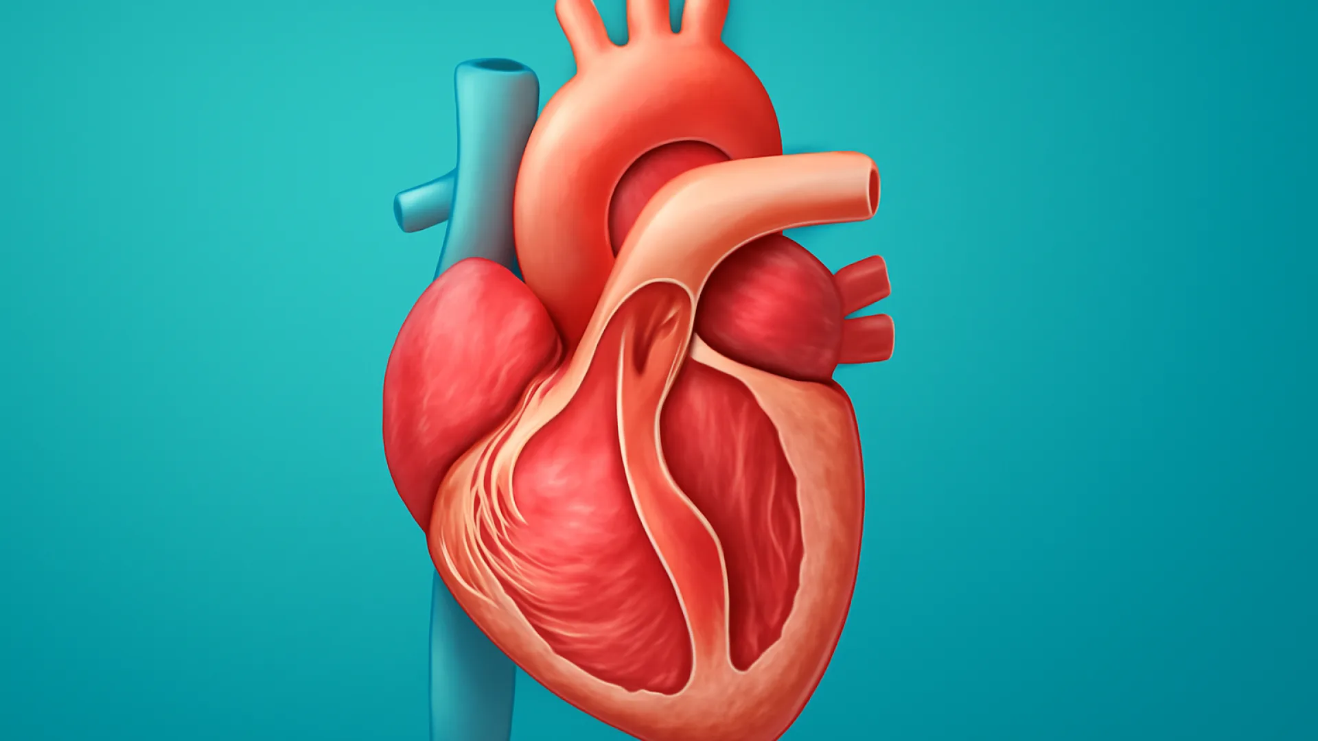 Regurgitasi Aorta (AR)