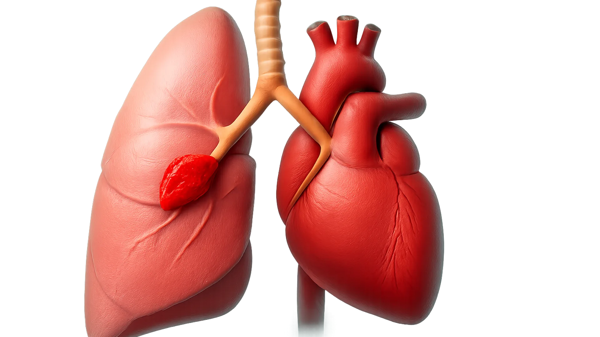 Emboli Paru (Pulmonary Embolism)