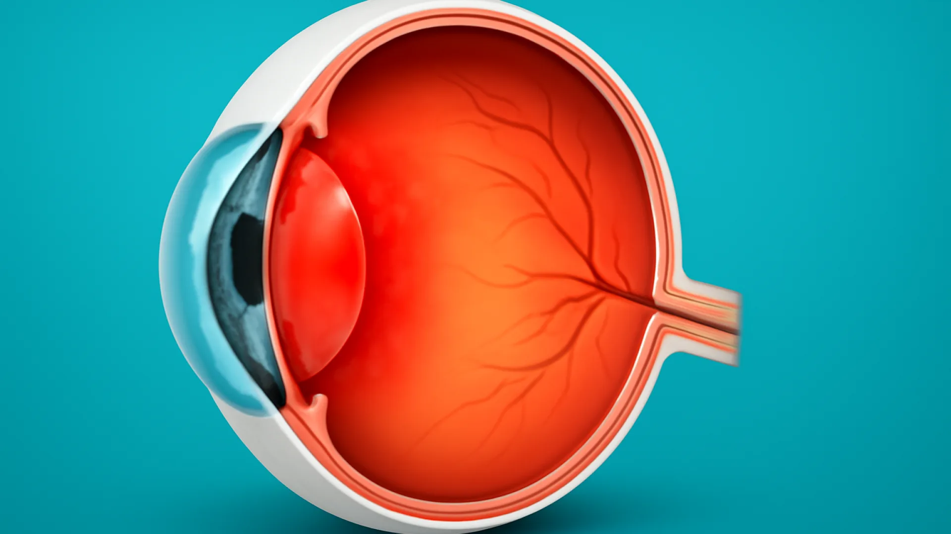 Uveitis: Anterior vs. Posterior