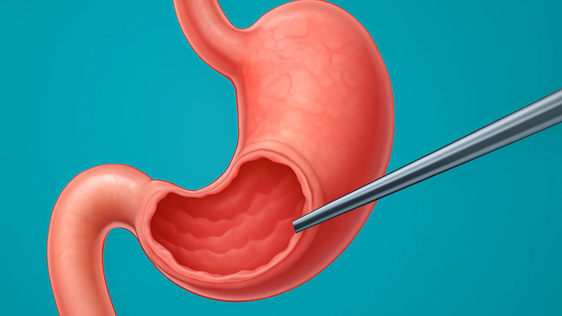 Stenosis Pilorus Hipertrofi Infantil