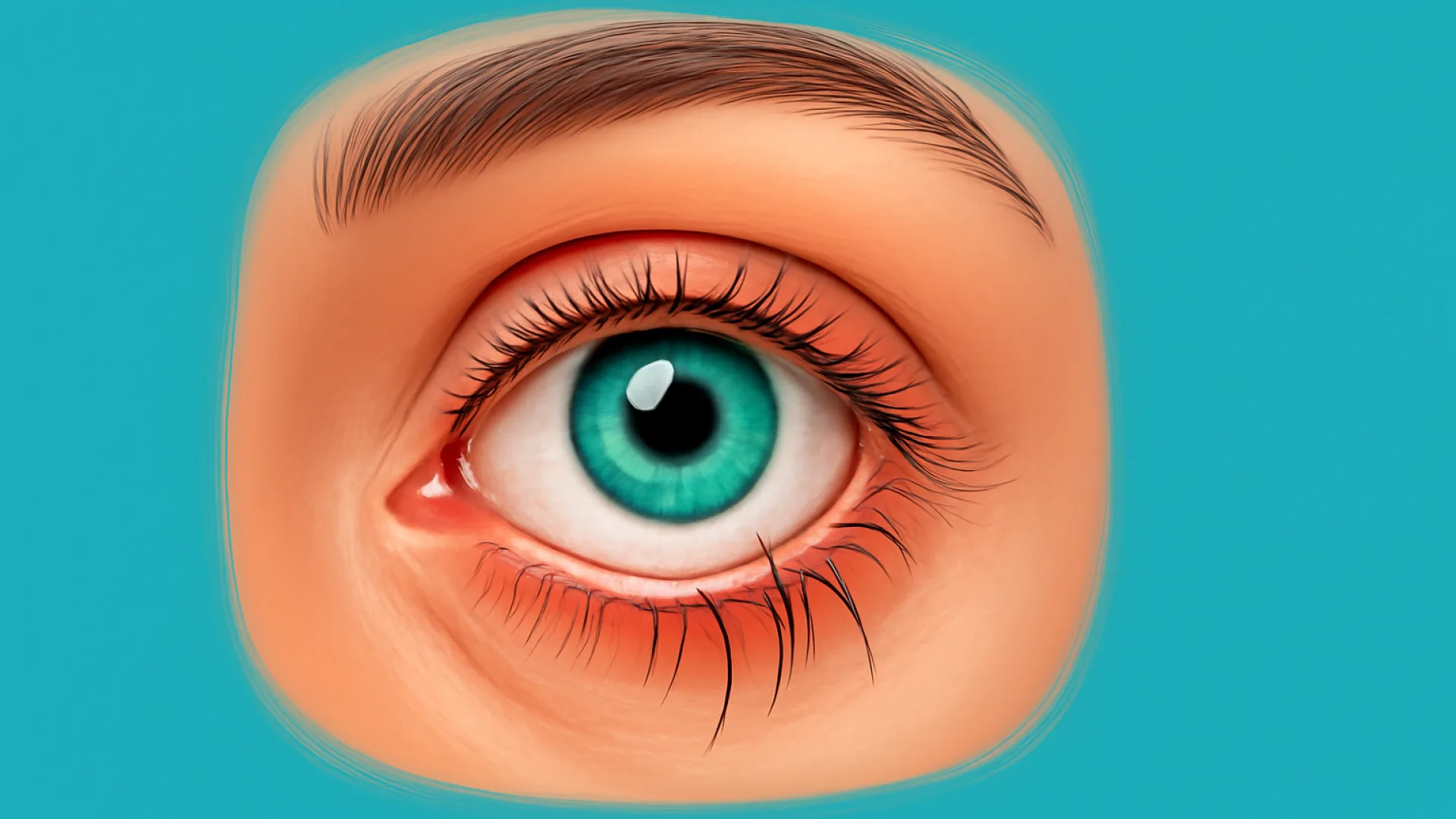 Trichiasis dan Distichiasis