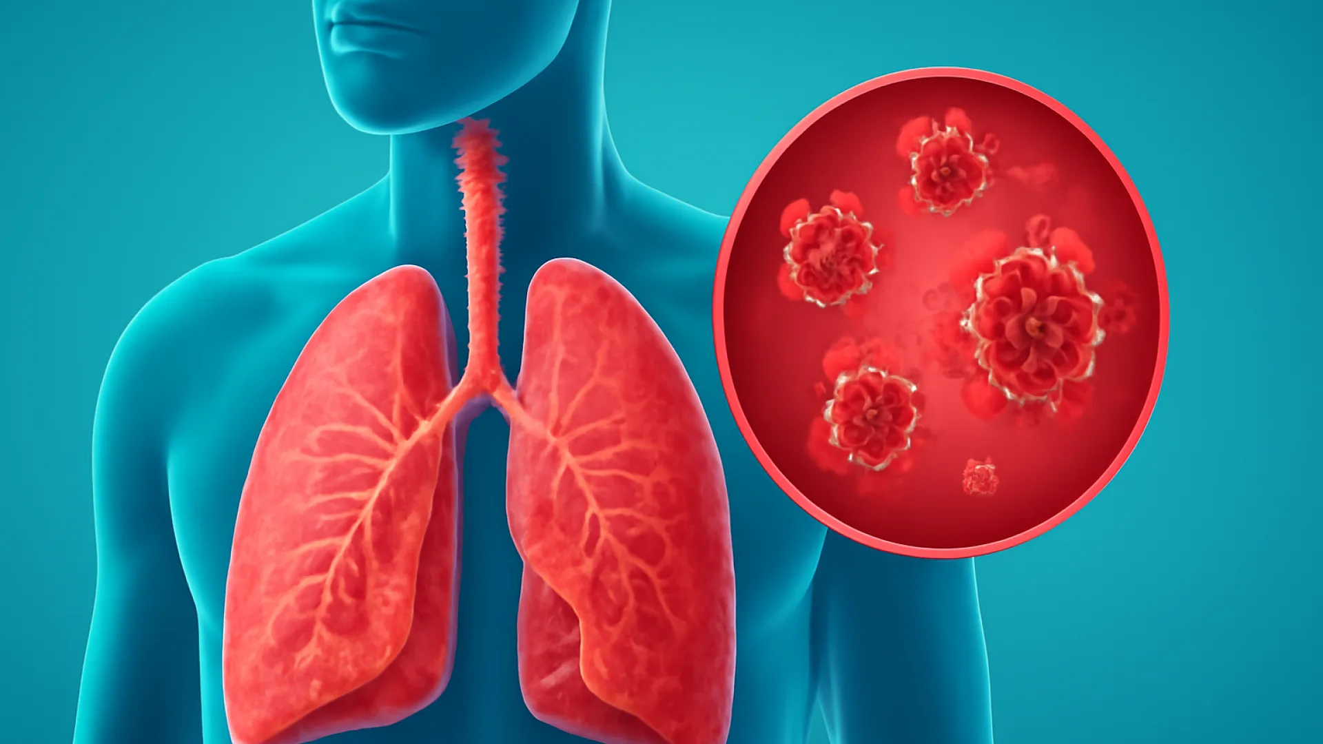 Pneumonia Atipikal