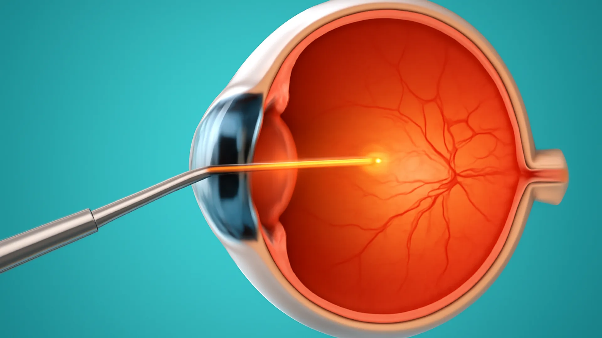 Ablasio Retina