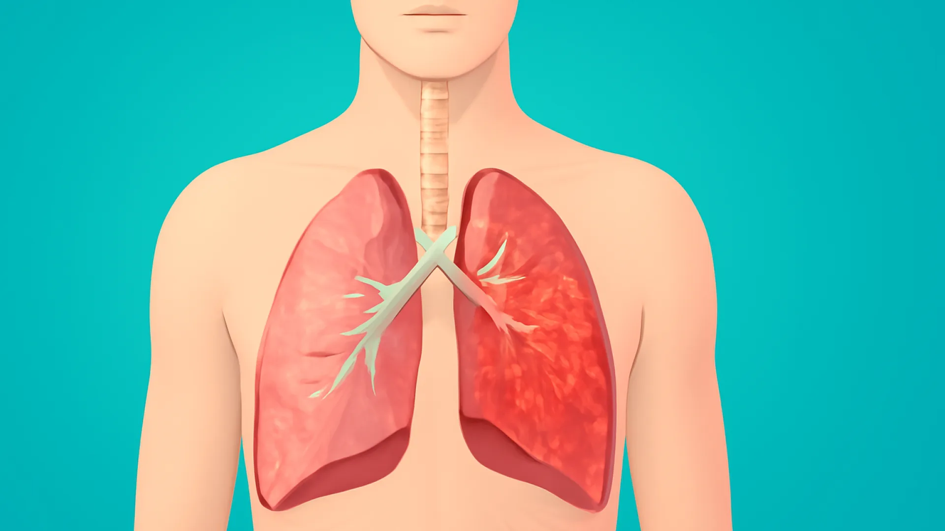 Pneumonia Komunitas (CAP)
