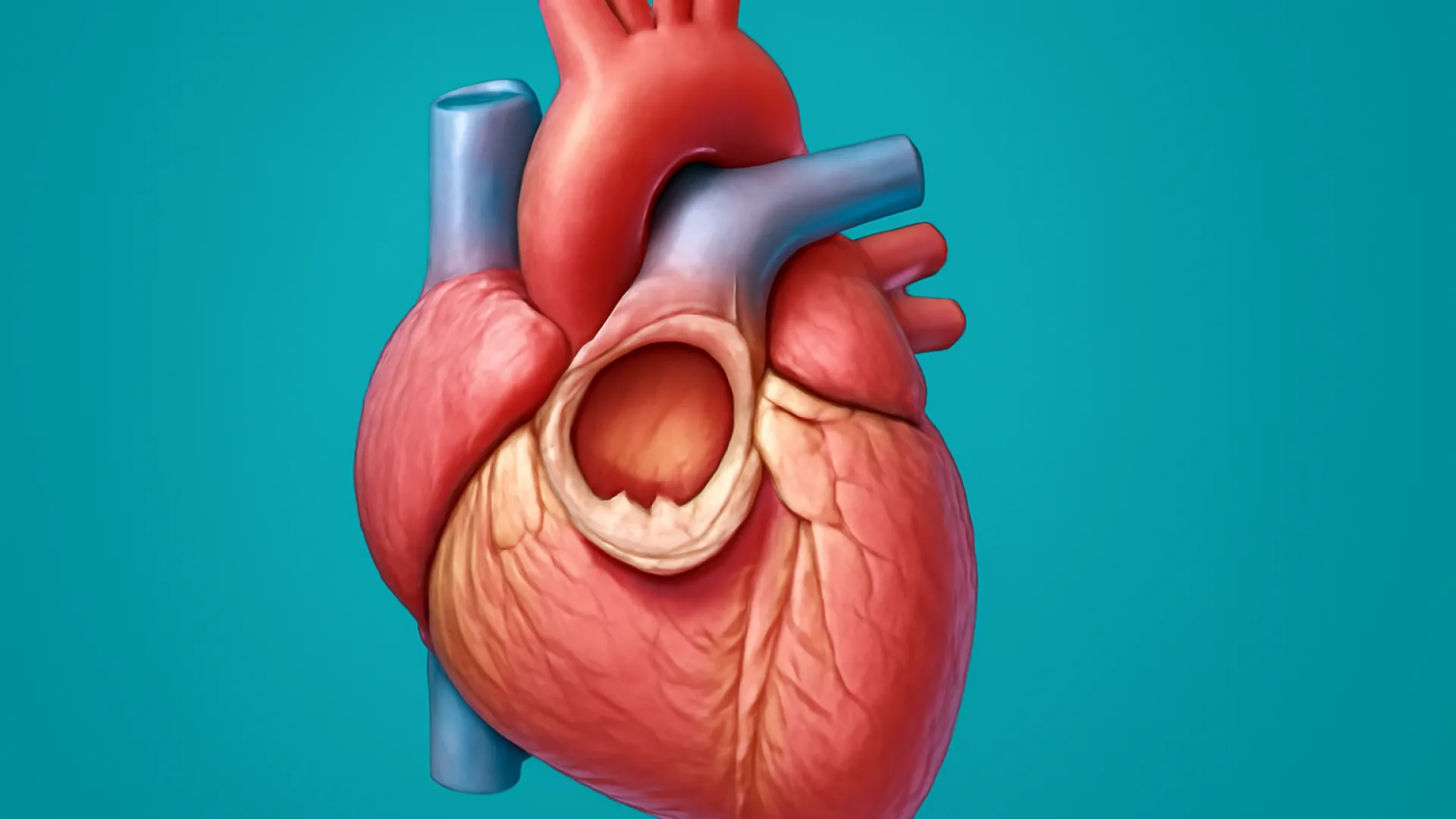 Stenosis Mitral