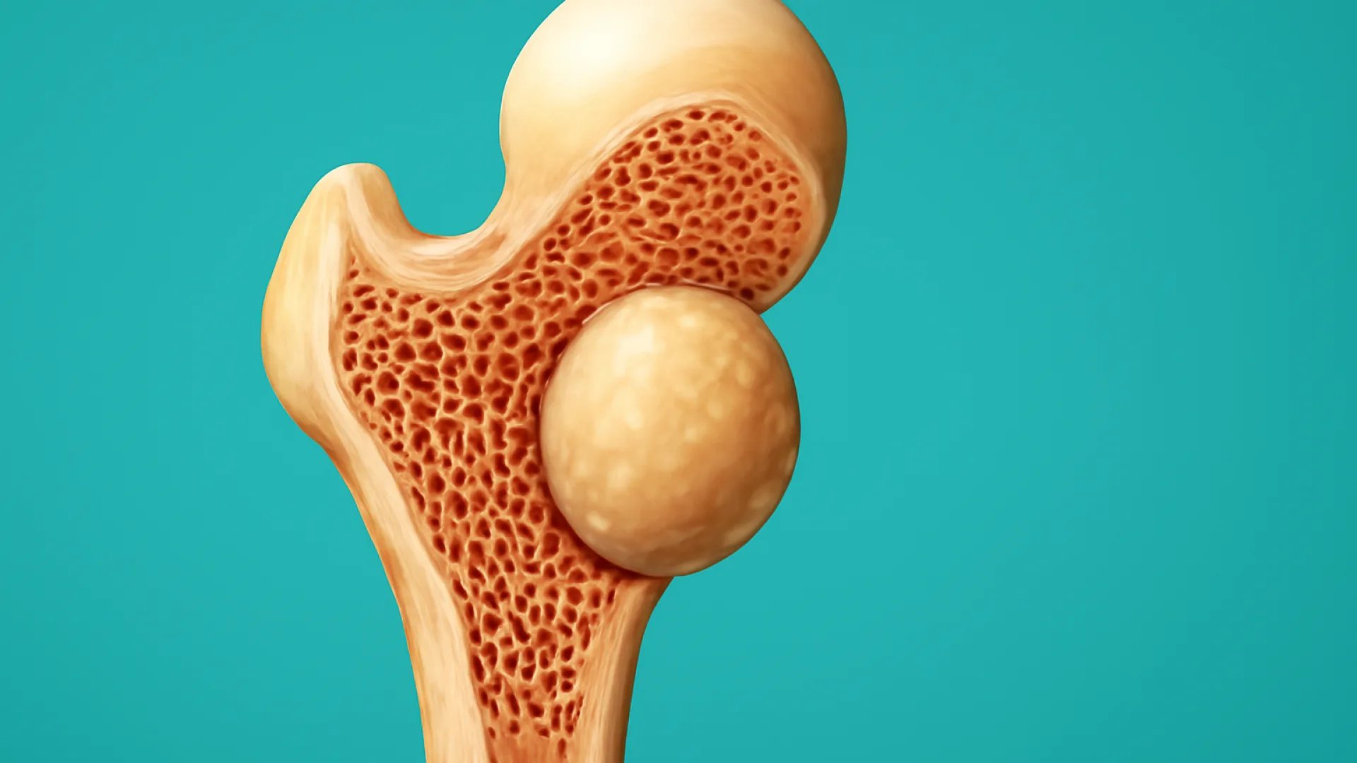 Tumor Tulang Jinak
