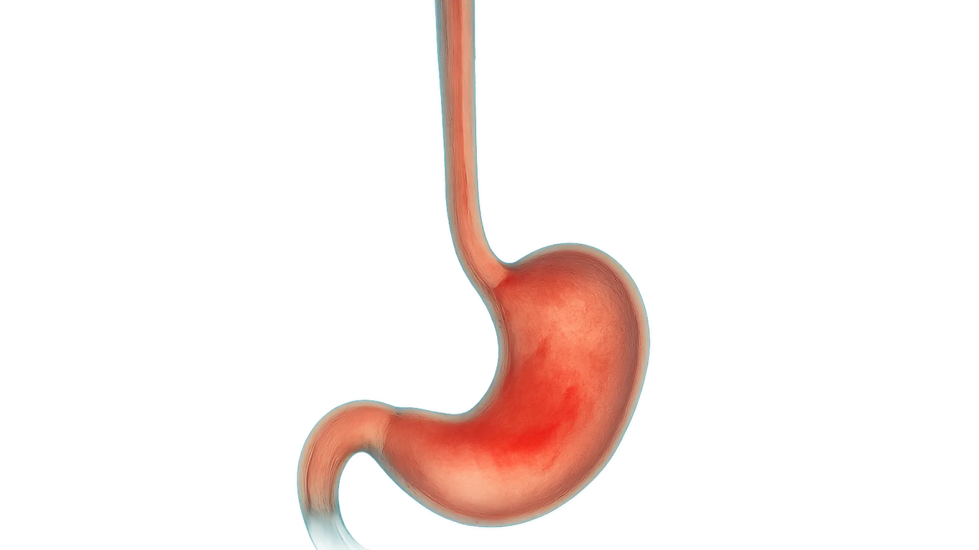 Gastritis, GERD, dan PUD: Patofisiologi, Diagnosis, dan Tatalaksana