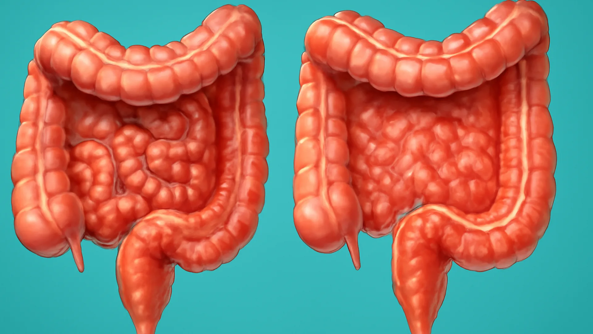 IBD: Crohn's Disease vs. Ulcerative Colitis