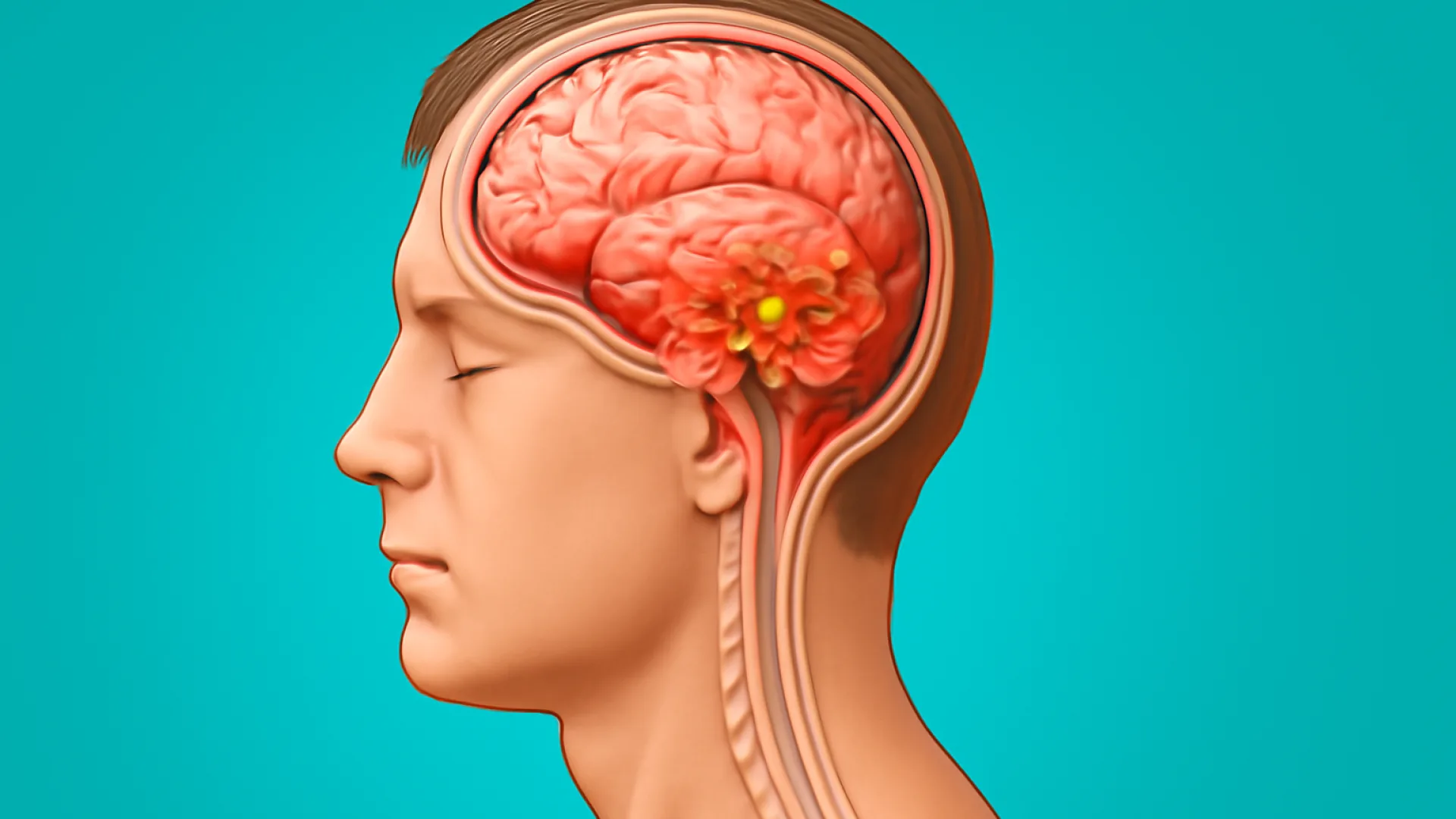 Meningitis Bakterial Akut
