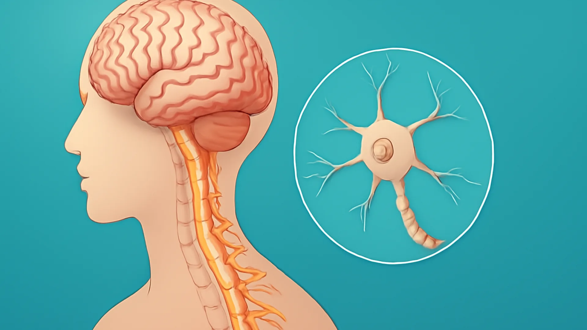Multiple Sclerosis (MS)