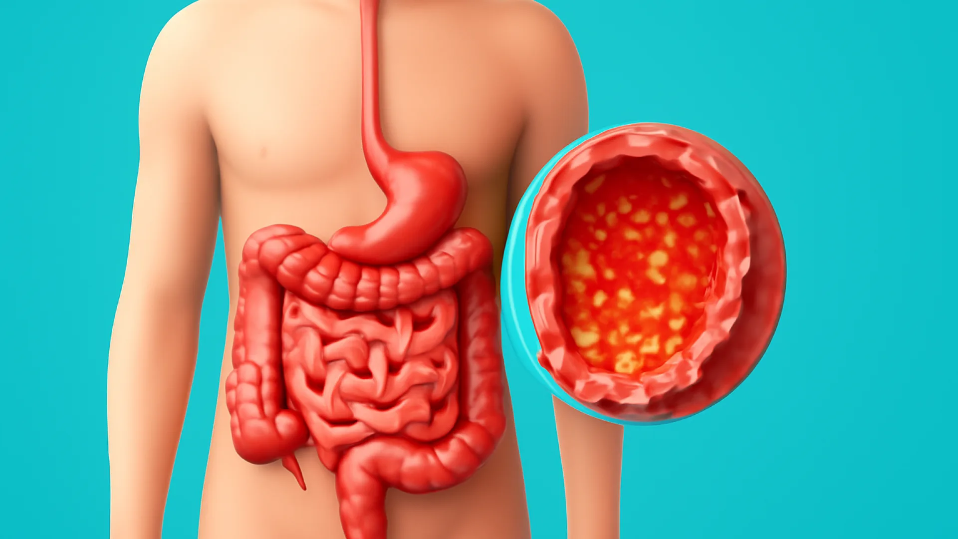 Gastroenteritis (Diare Infeksi)