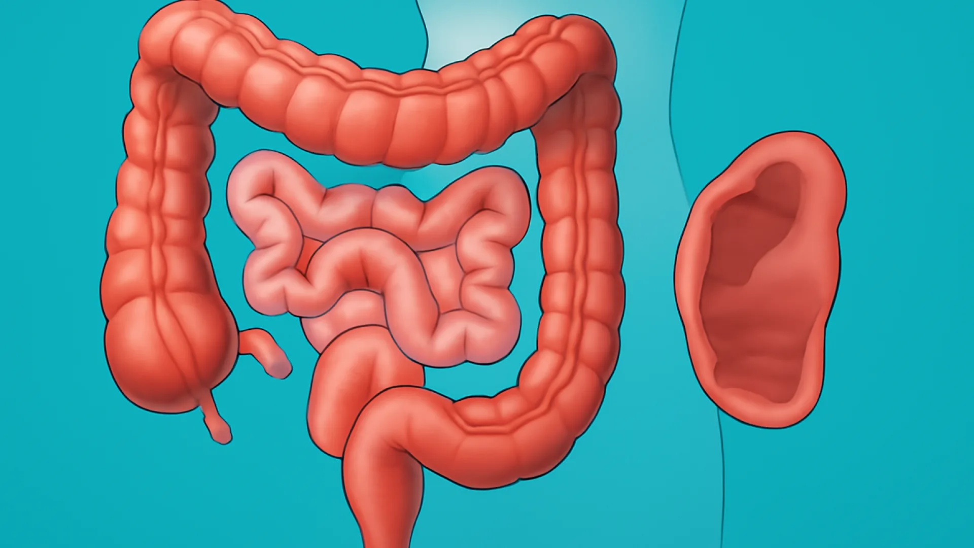 Ileus Obstruktif vs Ileus Paralitik
