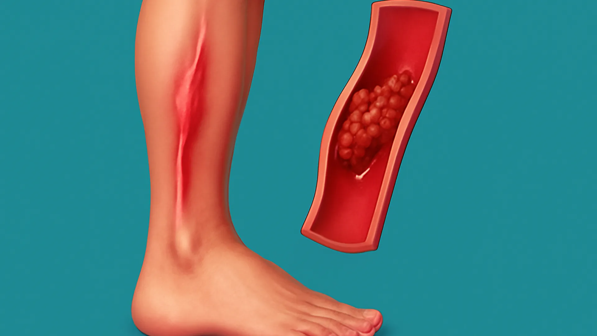 Trombosis Vena Dalam (DVT) dan Tromboflebitis Superfisial