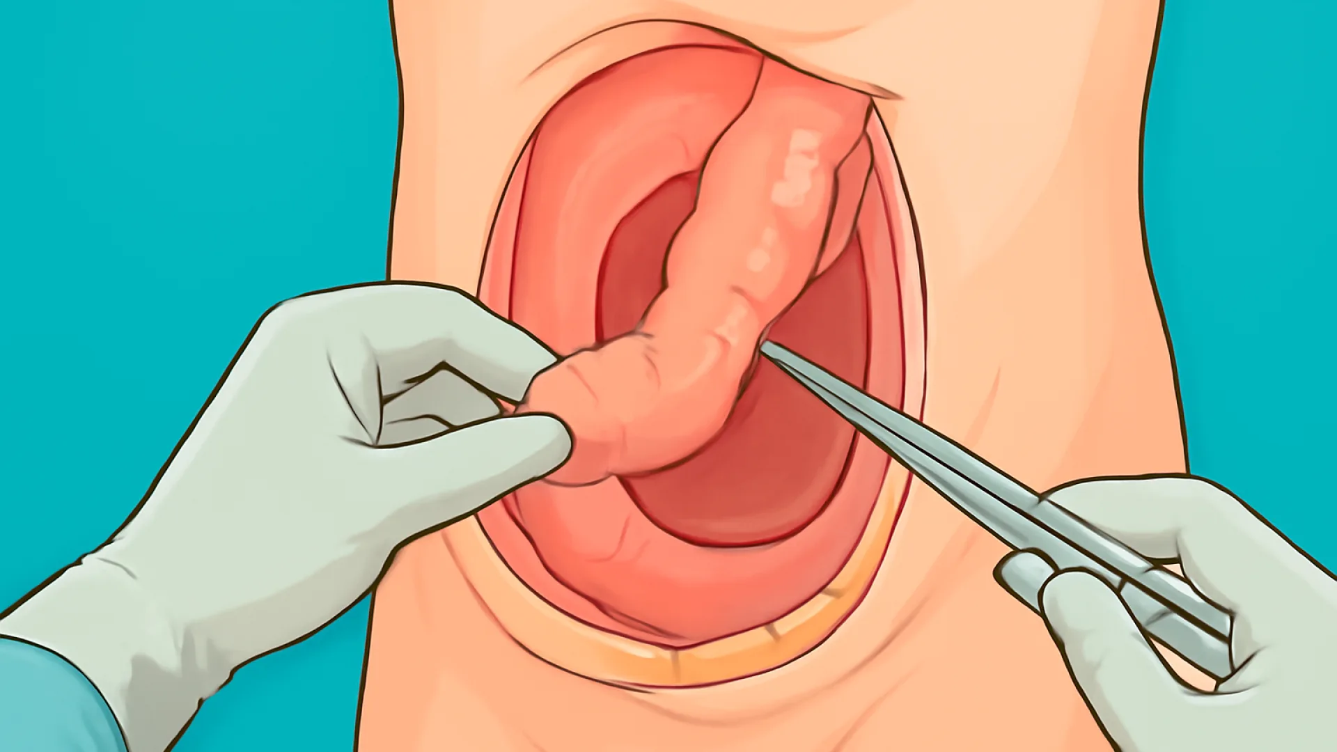 Klasifikasi & Karakteristik Hernia Dinding Abdomen